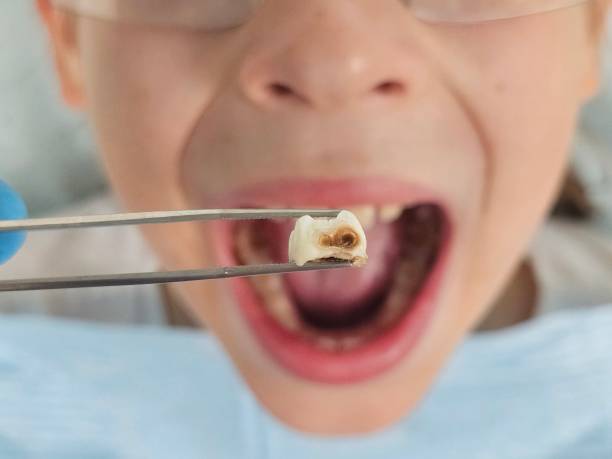 Best Broken or Cracked Tooth Emergency Dentist in Brook Highland, AL